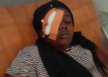 Siguiri/Doko : Fatoumata Diallo violemment battue par son amant, risque de perdre son œil droit