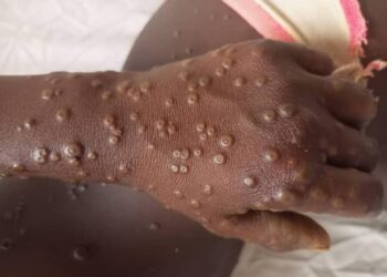 Alerte: 18 cas de Mpox détectés et confirmés en Guinée, selon l’ANSS