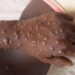 Alerte: 18 cas de Mpox détectés et confirmés en Guinée, selon l’ANSS