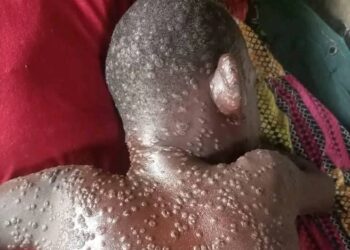 Guinée: 7 épidémies actives dans 13 localités, niveau d’alerte relevé