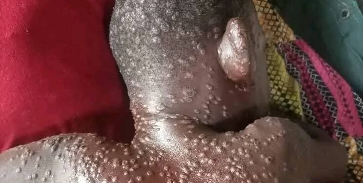 Guinée: 7 épidémies actives dans 13 localités, niveau d’alerte relevé