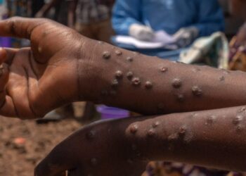 Mpox en Guinée : 271 cas confirmés