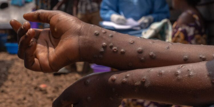 Mpox en Guinée : 271 cas confirmés