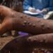 Mpox en Guinée : 271 cas confirmés