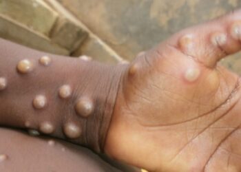 Mpox (variole du singe): 15 districts touchés en Guinée