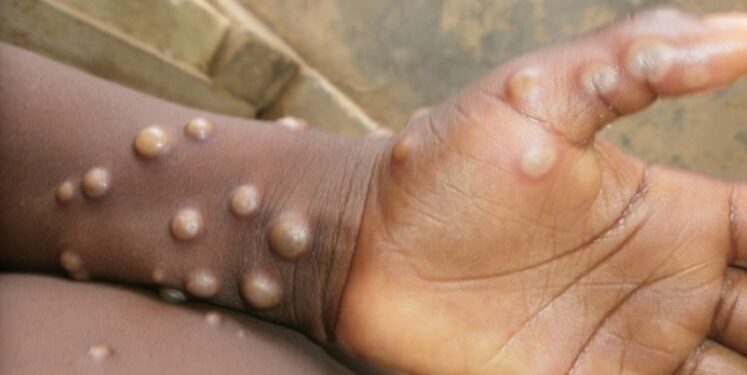 Mpox (variole du singe): 15 districts touchés en Guinée