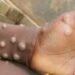 Mpox (variole du singe): 15 districts touchés en Guinée