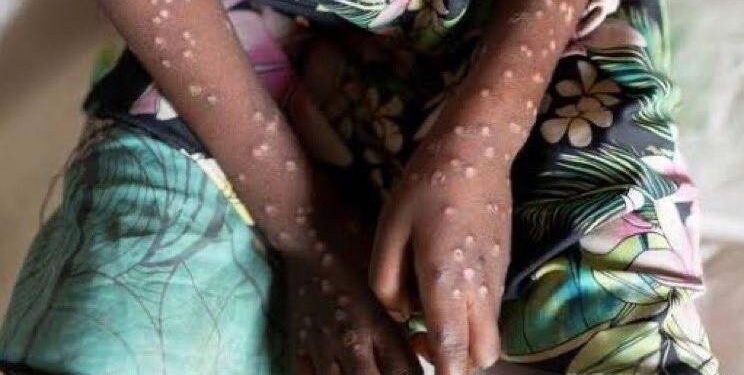 Variole du singe : plus de 380 cas confirmés en Guinée, l’alerte sanitaire monte