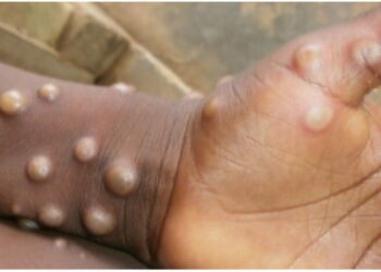 Mpox en Guinée : 12 districts sanitaires touchés par le virus