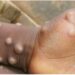 Mpox en Guinée : 12 districts sanitaires touchés par le virus