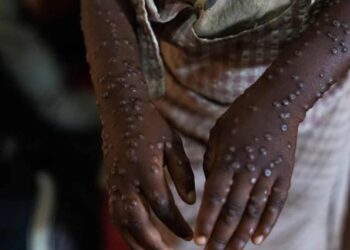 Sénégal: deuxième cas confirmé de Mpox à Dakar 