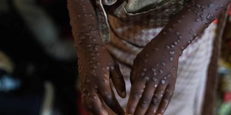 Sénégal: deuxième cas confirmé de Mpox à Dakar 