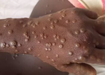 Sénégal: 8 morts liés à la Fièvre de la Vallée du Rift, 5 cas de Mpox à Dakar
