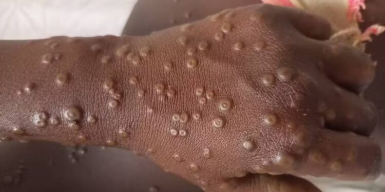 Sénégal: 8 morts liés à la Fièvre de la Vallée du Rift, 5 cas de Mpox à Dakar