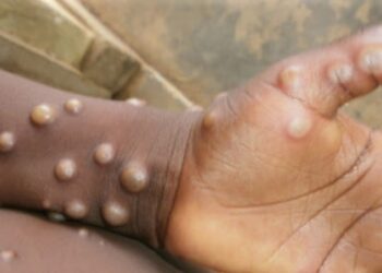 Lutte contre la variole simienne (Mpox): 20.000 doses de vaccin réceptionnées par l’ANSS