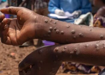 Épidémies au Sénégal: 90 cas de FVR, dont 11 décès, et 5 cas de Mpox enregistrés au 5 octobre 