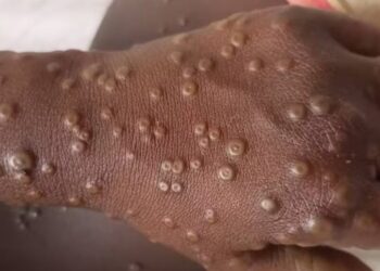 Sénégal : 13 nouveaux cas de FVR en 24h, 324 au total dont 28 décès et 7 cas de Mpox recensés à Dakar