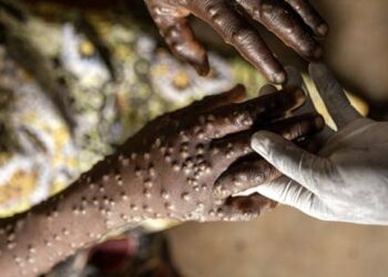 Sénégal: 514 cas de FVR et 9 cas confirmés de Mpox 