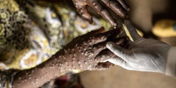 Sénégal: 514 cas de FVR et 9 cas confirmés de Mpox 