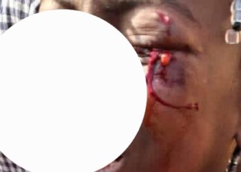 Grève de l’intersyndicale: l’élève blessée à l’œil gauche étudie à l’école primaire (Japon) de Bailobaya