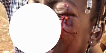 Grève de l’intersyndicale: l’élève blessée à l’œil gauche étudie à l’école primaire (Japon) de Bailobaya