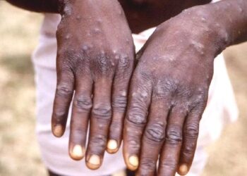 Epidémie de Mpox : la Guinée compte actuellement 7 districts touchés, selon l’ANSS