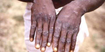 Epidémie de Mpox : la Guinée compte actuellement 7 cas confirmés, selon l’ANSS