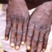 Epidémie de Mpox : la Guinée compte actuellement 7 districts touchés, selon l’ANSS