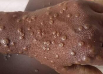 Mpox en Guinée : ce qu’il faut savoir pour se protéger (ANSS)