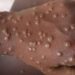 Mpox en Guinée : ce qu’il faut savoir pour se protéger (ANSS)