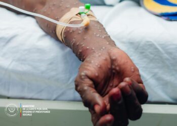 Mpox en RDC : après trois ans de lutte, l&rsquo;épidémie n&rsquo;est plus une urgence nationale