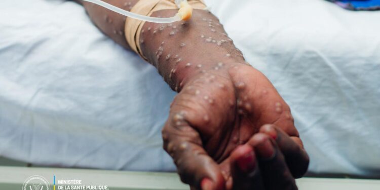 Mpox en RDC : après trois ans de lutte, l&rsquo;épidémie n&rsquo;est plus une urgence nationale